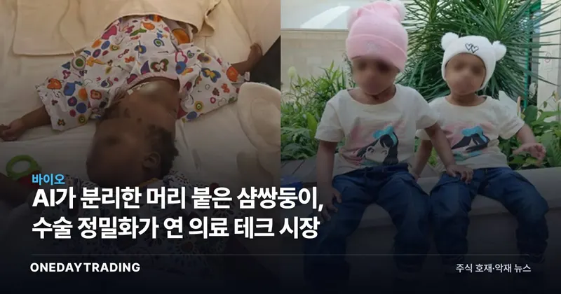 AI가 분리한 머리 붙은 샴쌍둥이, 수술 정밀화가 연 의료 테크 시장